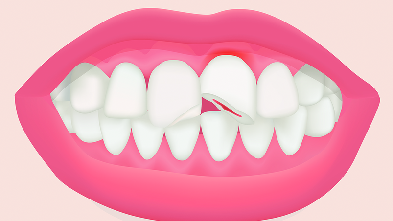 Zahn-Erste-Hilfe